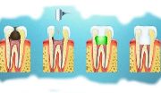 Лечение острого пульпита зуба