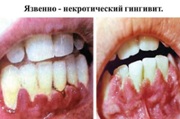 Острый язвенно некротический гингивит