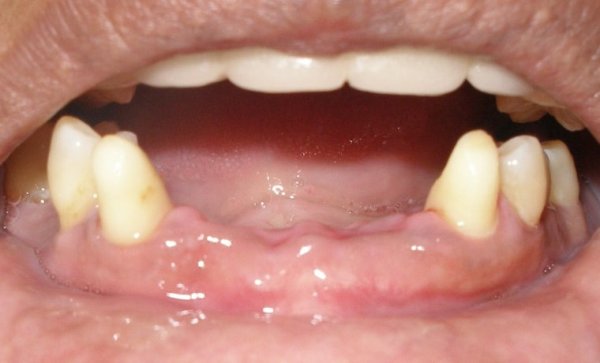 Протезы dental d