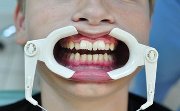 удаление сверхкомплектного зуба