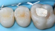 Цементная пломба на зуб