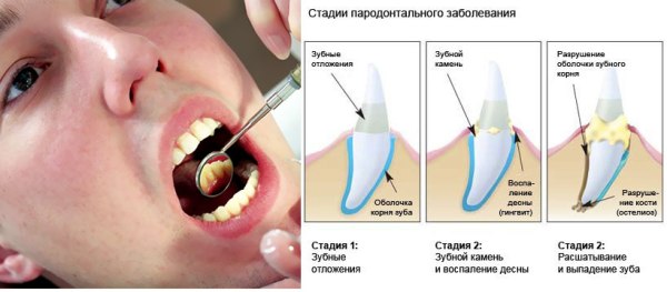 Уколы в десна при пародонтозе отзывы