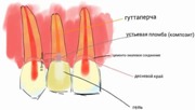 Внутриканальное отбеливание зубов отзывы