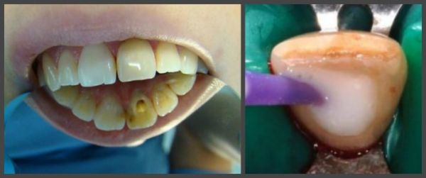 Внутриканальное отбеливание зуба методика