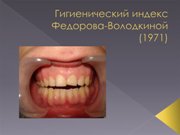 Гигиенический индекс полости рта