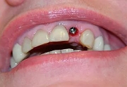 Имплантация передних верхних зубов
