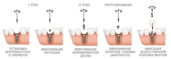 Имплантация передних зубов фото до и после