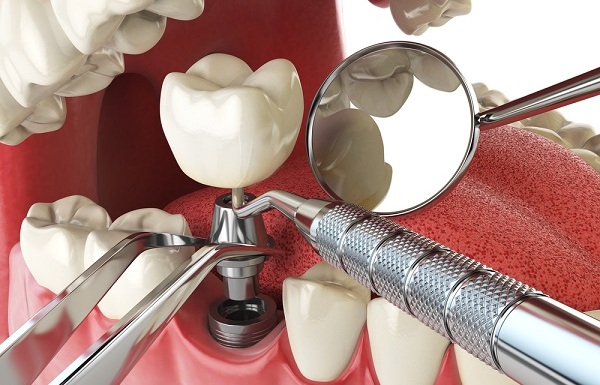 Виды имплантации зубов плюсы и минусы