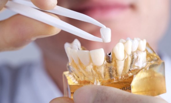 Плюс и минусы современных способов имплантации зубов