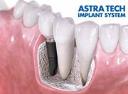 Особенности имплантов Астра Тек
