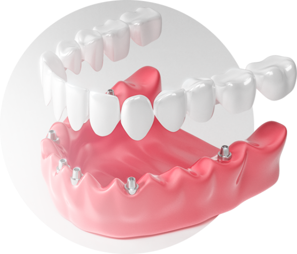 Комплексная имплантация зубов цены