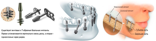 Курение и имплантация зубов отзывы