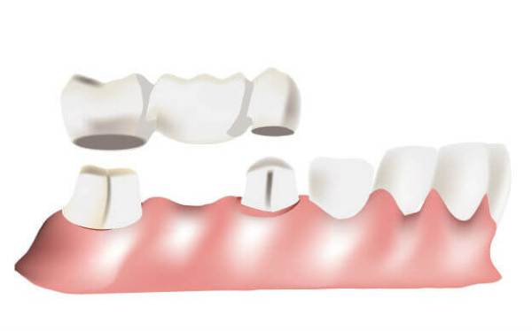 Имплантация зубов плюсы и минусы отзывы