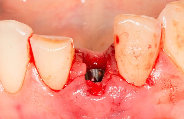 Высокая температура после имплантации зубов