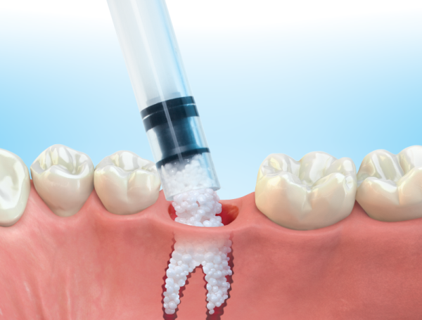 Инструкция по использованию Easy Graft в стоматологии