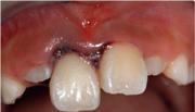 Хирургическая репозиция зуба