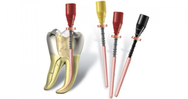 Этапы обтурации корневых каналов зубов гуттаперчей