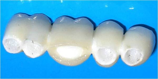 Полное восстановление коронки зуба