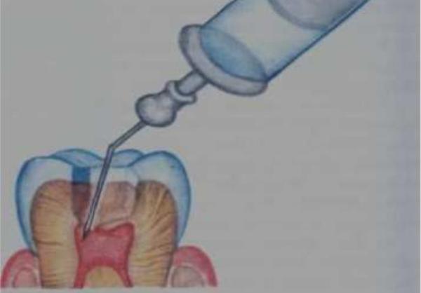 Подготовка зуба для проведения внутрипульпарной анестезии