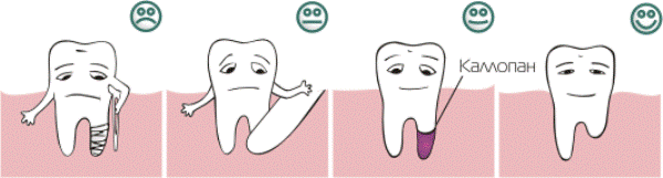 Коллапан в стоматологии инструкция