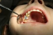 Лечение инфекции зуба
