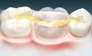 Восстановление зуба риббонд