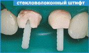 Восстановление зуба на стекловолоконном штифте
