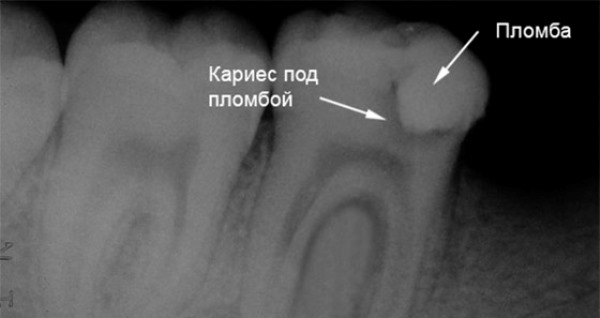 Вторичный кариес депульпированного зуба
