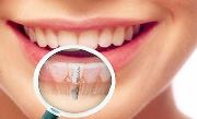 Плюсы имплантации зубов