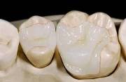 Керамические вкладки на зубы отзывы