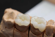 Керамические вкладки на зубы отзывы