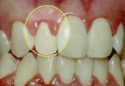 Коагуляция десны в стоматологии