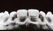 Восстановление контактного пункта зубов
