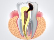 Лечение острого пульпита зуба