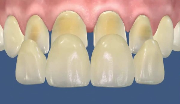 Особенности препарирования опорных зубов