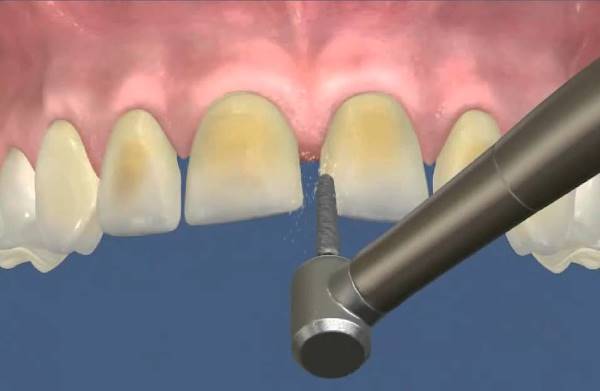 Особенности препарирования зубов при пломбировании