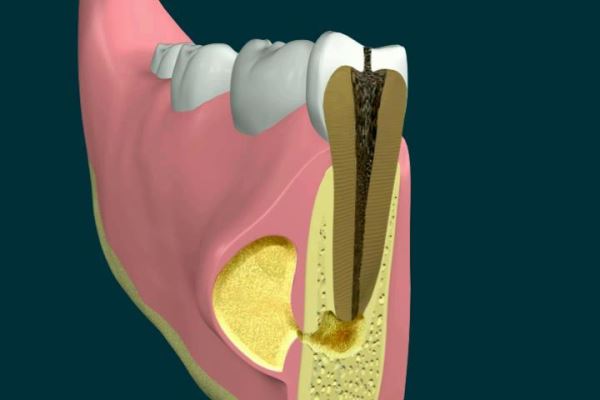 Хронический апикальный периодонтит зуба патогенез и лечение