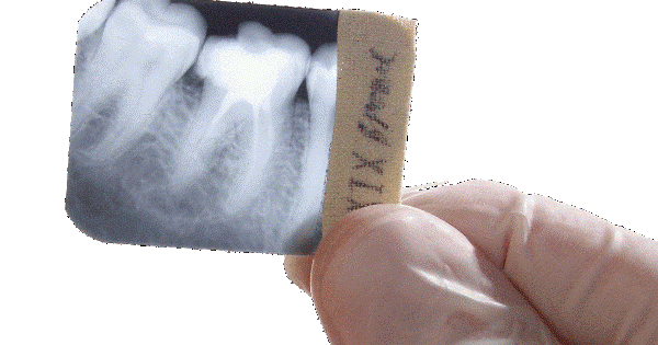 Перелом корня зуба под коронкой симптомы