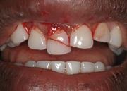 Перелом коронки зуба по мкб 10