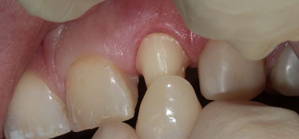 Потемнение зуба после удаления нерва