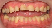Повышенное стирание зубов