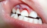 Лечение травм зубов у детей