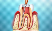 Экстирпация пульпы зуба