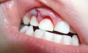 Травма зубов лечение