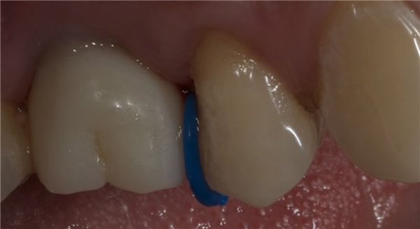 Как устанавливается сепарационное кольцо в ортодонтии