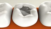 Цементная пломба на зуб