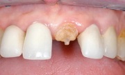 Восстановление разрушенной коронки зуба