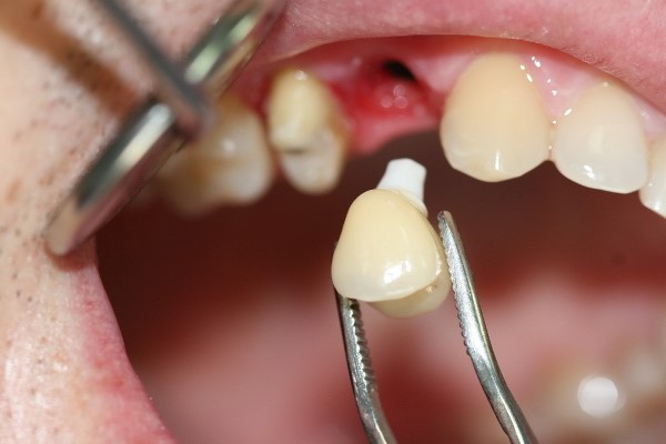 Бады для приживления зубных имплантов