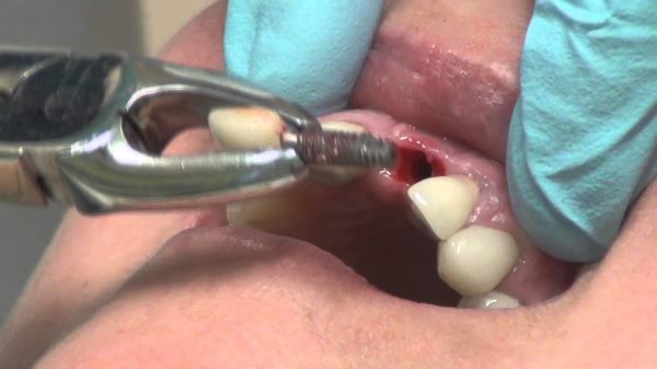 Можно ли остановить отторжение зубного импланта