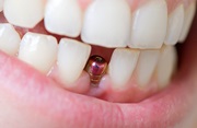 Осложнения после имплантации верхних зубов